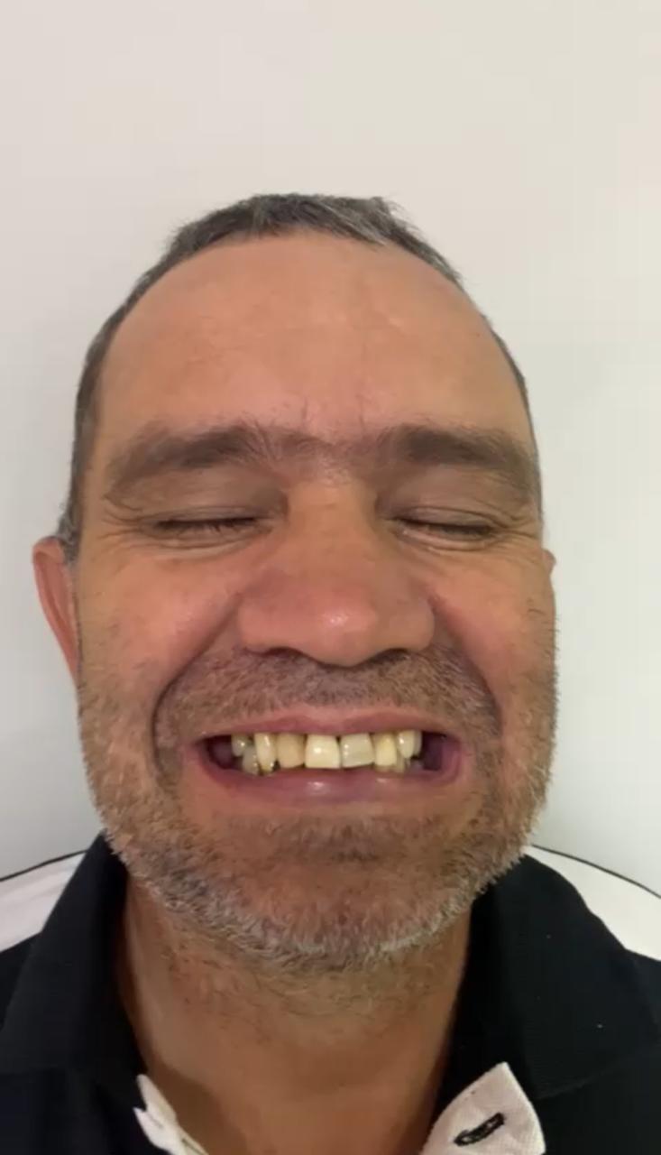 Mr. Edemilson — before Full Arch Protocol