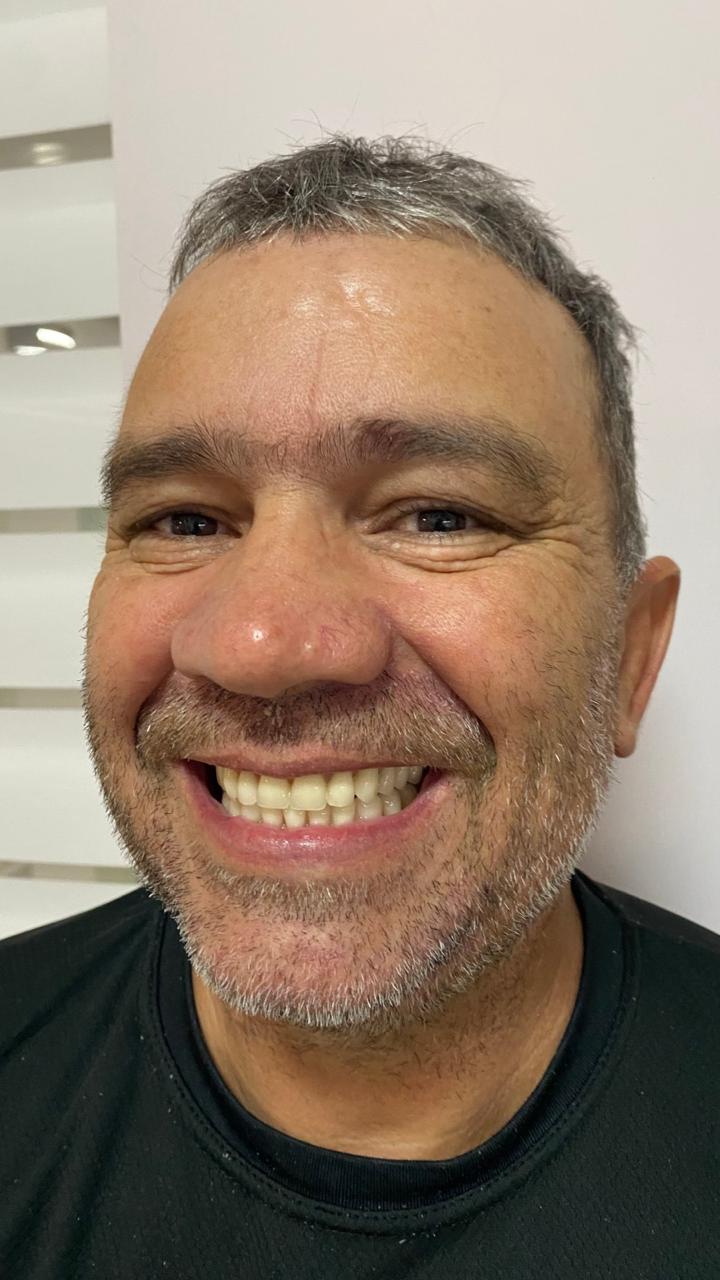 Mr. Edemilson — after Full Arch Protocol