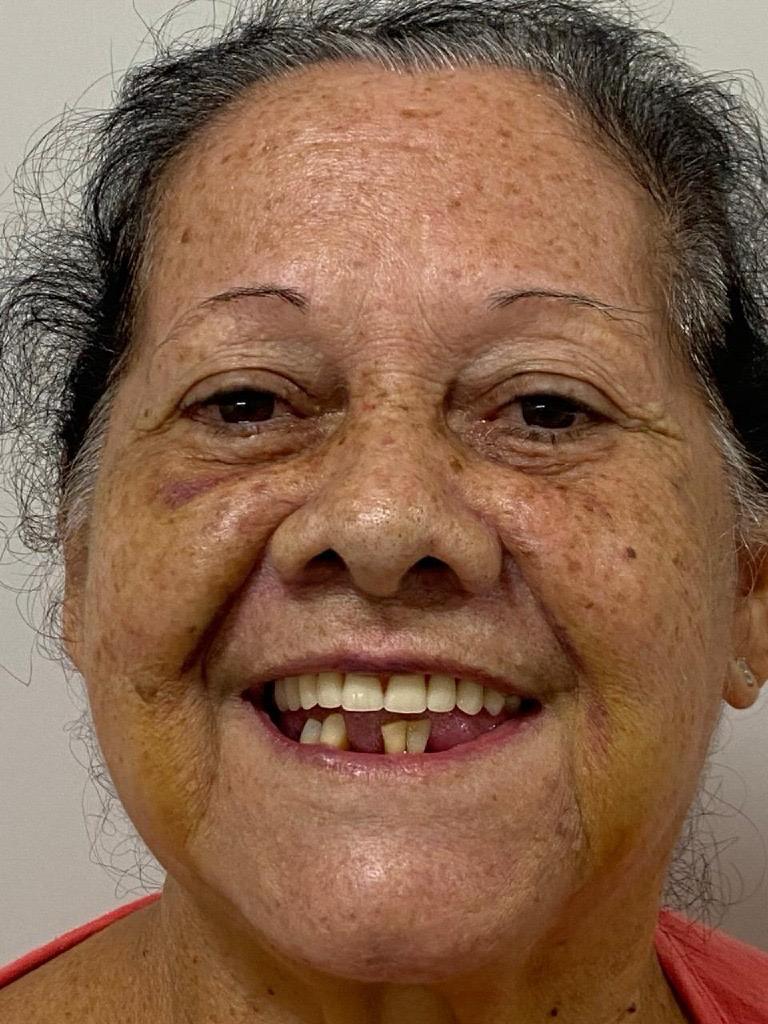 Mrs. Maria Antonia — before Full Arch Protocol
